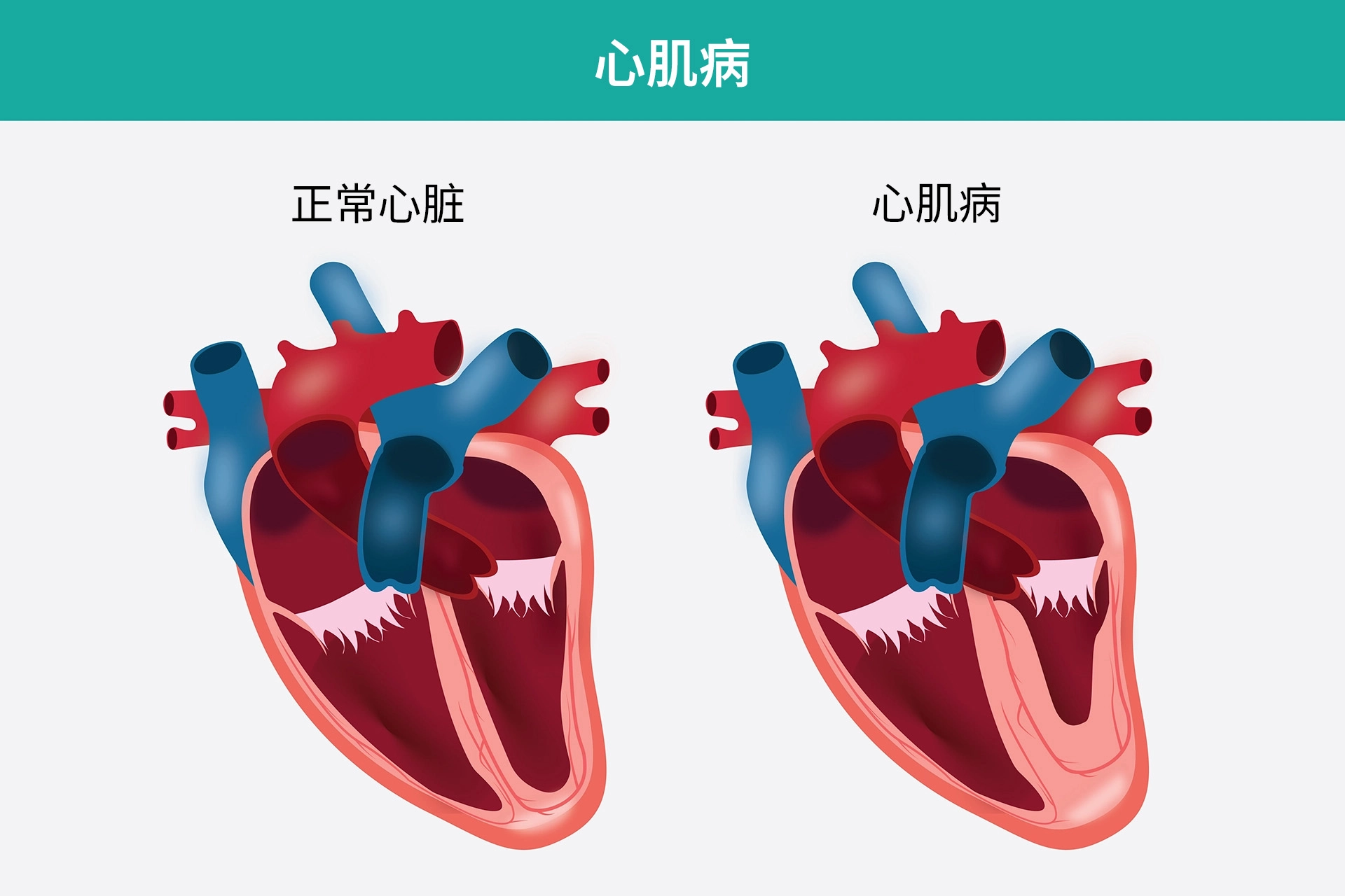 Cardiomyopathy