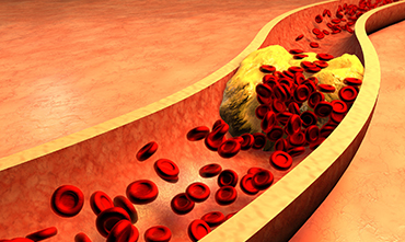 Coronary Artery Disease