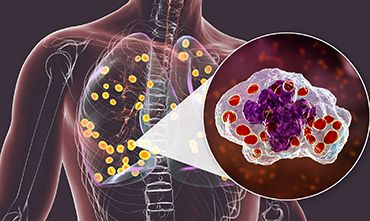 Lung Nodules