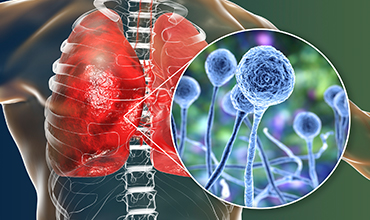 Thoracic Disease