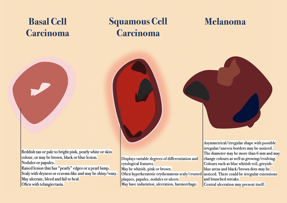 Is it really just a mole? This dermatologist teaches us how to spot skin cancer (фото 2)