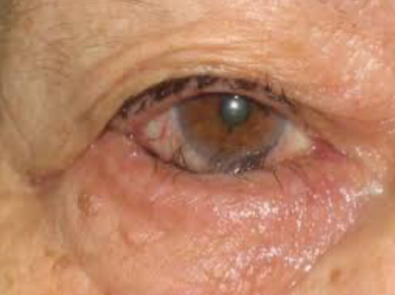 Trichiasis