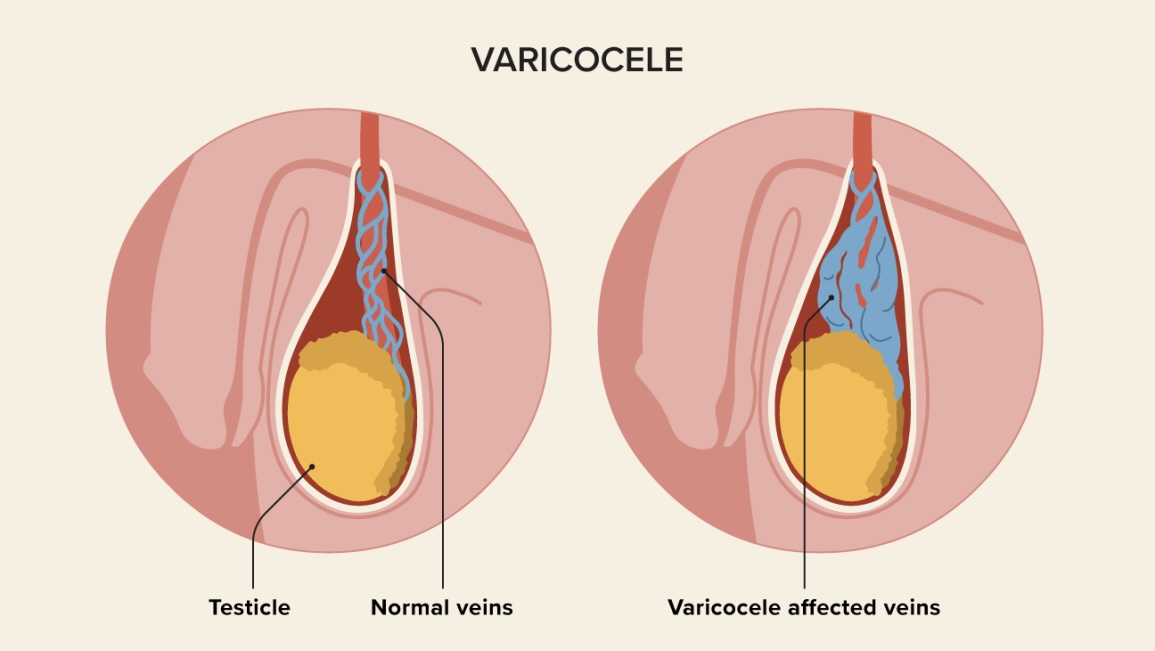 What Is a Varicocele?
