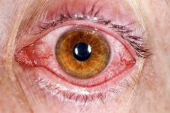 Conjunctivitis (Pink Eye)