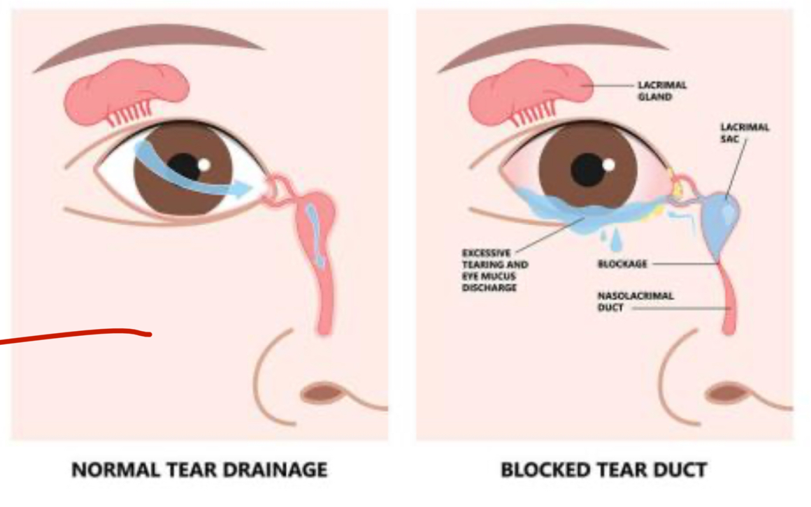 Blocked Tear Duct