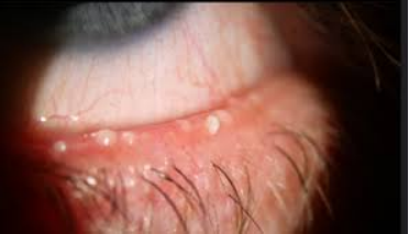 Dry Eyes (Insufficient Tear Quality)