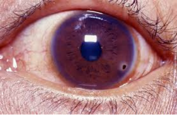 Foreign Body in the Eye