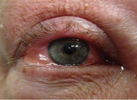 Blepharitis