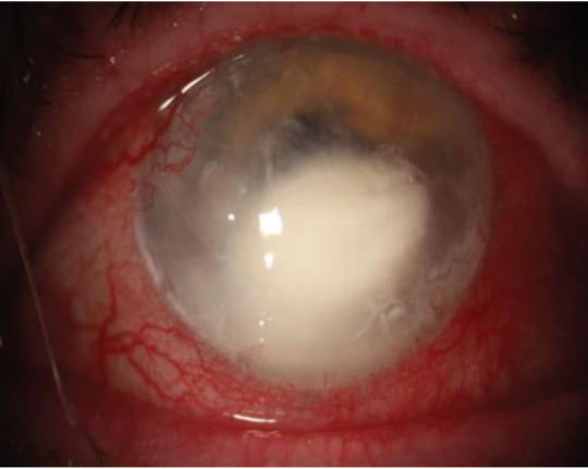 Corneal Abrasions or Ulcers
