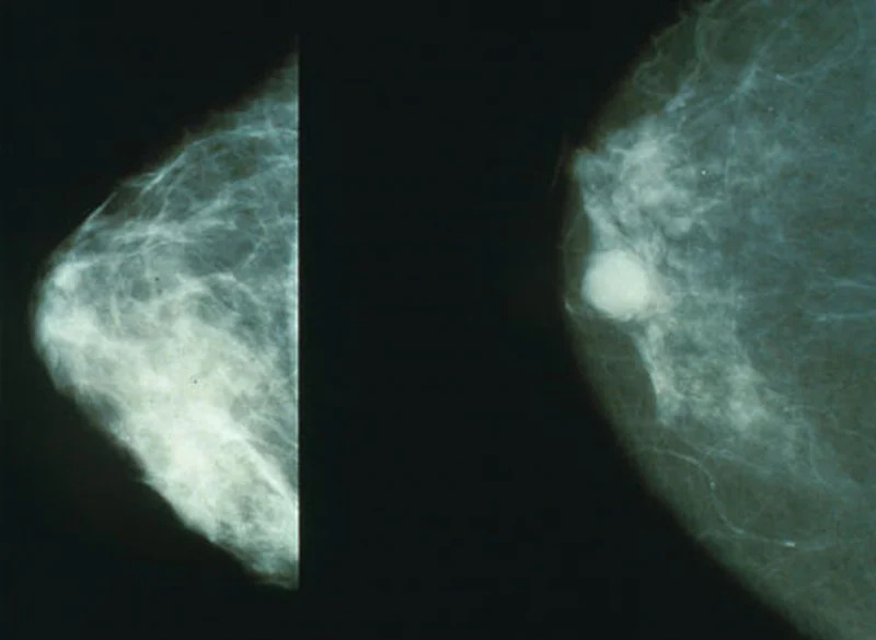 Normal (left) versus cancerous mammography imaging. (Wikipedia pic)